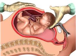 Normal Delivery & Caesarean Section