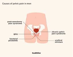 Pelvic Pain Management